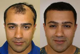 Advanced Hair Transplant Techniques in Illinois Kane North Aurora