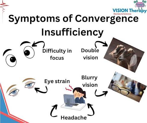 Symptoms of convergence insufficiency infographic