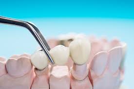 Expert Dental Bridges for Lasting Smiles | AZ Dentistry