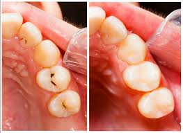 It Is A Common Belief That Once There S Tooth Decay Cavity Is Irreversible The Only Way To Get Rid Of It I Heal Cavities Dental Decay Remedies For Tooth Ache