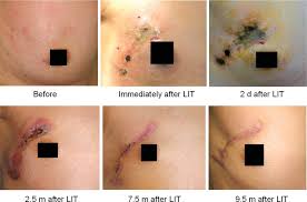 Symptoms of bone metastasis include: Photos Of Breast Lesions Of 47 Year Old Female Patient With Stage Iv Download Scientific Diagram