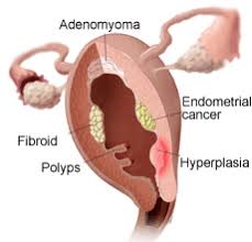 In more than 90 percent of women, unexpected abnormal vaginal bleeding is the most common early sign of uterine cancer. Endometrial Cancer Modern Cancer Hospital Guangzhou China