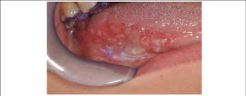 Image result for white cancer on tongue)