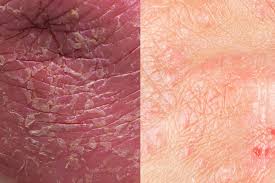 Image result for psoriasis