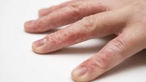 Obat psoriasis obat psoriasis paling ampuh, mujarab, serta manjur kini telah hadir untuk anda sebagai solusi untuk mengobati psoriasis yaitu obat herbal jelly gamat yang telah terbukti berkhasiat ampuh mengobati penyakit psoriasis secara alami tanpa menimbulkan efek samping, terbuat dari. Psoriasis Di Tangan Gejala Dan Rawatan Lichen Bersisik