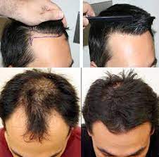 The Best Hair Transplant Procedure For Men Hair Transplant Sk Health Hair Transplant Procedure Hair Transplant Fue Hair Transplant
