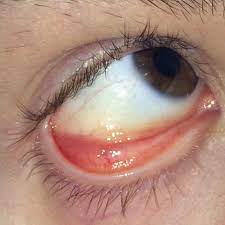Leicht Gelblicher Augapfel Gesundheit Medizin Augen