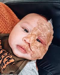 Trolls call Gold Coast mum a 'monster' for lasering port-wine stain  birthmark