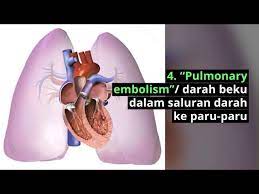 Berikut beberapa penyebab timbulnya rasa sakit pada dada sebelah kanan Sakit Dada Sebelah Kanan Penyebab Cara Mengatasi Doctoroncall