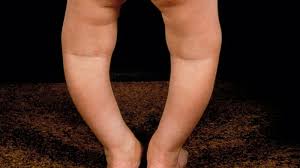 Image result for Rickets