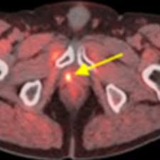But hearing the words can still be scary. Why You Should Rethink Pet Ct Imaging For Prostate Cancer Dms Health