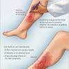 Who is the allergist for skeeter syndrome? 3