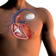 If an abnormal heart rhythm is detected the device will deliver an electric shock to restore a normal heartbeat if your heart is beating chaotically and. Global Implantable Cardioverter Defibrillator Icd Market 2021 Outlook And Study Of Top Players Medtronic Abbott Boston Scientific The Manomet Current