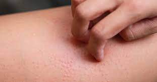 Urticaria este o manifestare de reacții alergice. Despre Urticarie Ce Este Simptome Diagnostic È™i Tratament