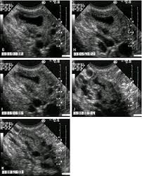 Image result for corpus luteum sonography)