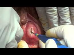 Imperforate Hymen With Late Repair Youtube