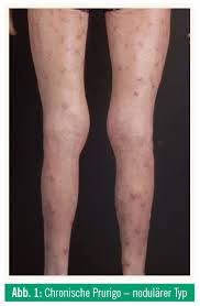 Epicutaneous sensitization with protein antigen induces localized allergic dermatitis and hyperresponsiveness kalavala m., dohil m.a. Klinisches Studienzentrum Chronische Prurigo Und Atopische Dermatitis Medmedia
