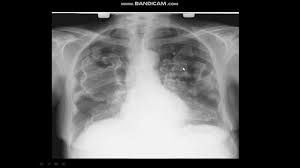 Asbestosis is a lung disease that develops when asbestos fibers cause scarring in your lungs. Interpretation Rx Type Asbestose Youtube