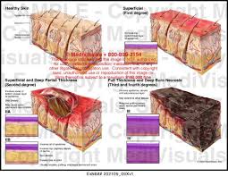 Depth Of Burn Injury Medical Exhibit Medivisuals Burn Injury Burns Nclex Prep