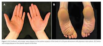 Learn everything you should know about pityriasis rubra pilaris treatments now. Facebook