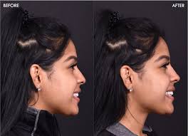 How much is it to get a nose job. Atlanta Non Surgical Rhinoplasty Sandy Springs Liquid Nose Job