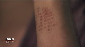Check spelling or type a new query. Florida Teen Recovering After Puss Caterpillar Sting Youtube