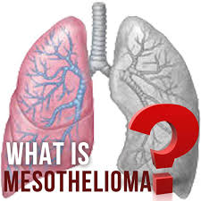liver cancer is the fourth most common cancer in the world. The Ultimate Guide To Mesothelioma Symptoms Prognosis Treatment Blog Aware Asbestos Removal Melbourne