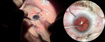 Image result for Cataract Extraction