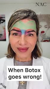 Expert Guide to Botox Brow Lift Techniques