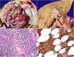 Inside pathology is an newsletter published by the chairman&#x27;s office to bring news and updates from inside the department&#x27;s research and to become familiar with those leading it. De Novo Double Hit B Cell Precursor Leukemia Lymphoma An Unusual Presentation As Peritoneal Lymphomatosis