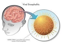 Die enzephalitis ist eine entzündung des gehirns, die am häufigsten viral . Encephalitis Causes Symptoms Treatment Clicks Health Hub