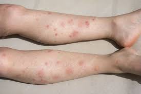 Allergic Reaction To Mosquito Bites Stock Image C047 4708 Science Photo Library