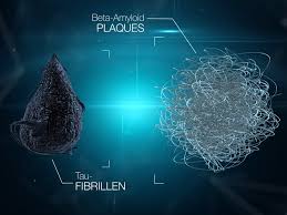 Specifically, the evidence demonstrates that aduhelm substantially reduces levels of amyloid, the protein that clumps into plaques and is the biomarker of the alzheimer's disease process; Aduhelm Neues Alzheimer Medikament In Den Usa Zugelassen Hersteller Muss Weitere Studie Auflegen Alzheimer Forschung Initiative E V Afi