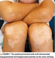 If your job wants you to roam around in the sun then you are exposed to sunlight for most of the time. Boy S White Patches Signal Pigmentary Disorder