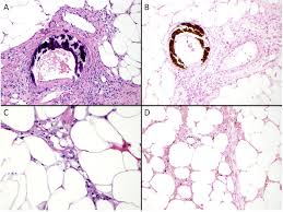 Image result for Calciphylaxis