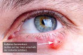 Was Ist Ein Inneres Gerstenkorn Und Wie Wird Es Behandelt