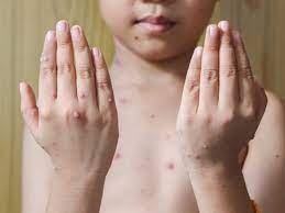 Alcuni sintomi possono aiutare ad individuare la causa della piastrinopenia, per esempio in la piastrinopenia non è un comune disturbo e richiede una accurata indagine sulle sue cause ed una. Morbillo Cos E Cause Sintomi Diagnosi Decorso Cure E Prevenzione