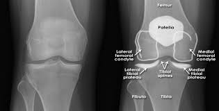 Image result for Knee XRay