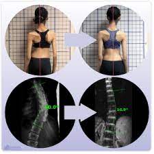 Silicon Valley Scoliosis Method Effective Treatment Without Surgery