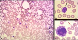 This type of bone marrow contains hematopoietic stem cells, which are the stem cells that form blood cells. Peripheral Blood And Bone Marrow Morphology A Bone Marrow Biopsy Download Scientific Diagram