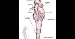 Short And Long Term Side Effects From Corticosteroids Medical Terms Steroids Side Effects Side Effects