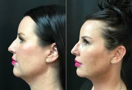 Optim Cryotherapy (@OptimCryo) • Facebook