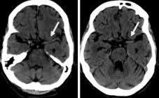 ¿es posible reanimar a alguien cuyo encéfalo ha dejado de funcionar? Tac De Craneo Que Muestra Signos Tempranos De Isquemia Cerebral Download Scientific Diagram