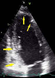 Man unterscheidet akute von chronischen formen der herzmuskelentzündung, wobei die akute myokarditis in eine chronische übergehen kann. Echocardiography Open Research Authorea