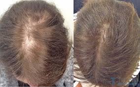 A dermatologist is specially trained in diagnosing and treating disease of the hair follicle and will evaluate a patient's hair loss by inquiring about diet, medications, family history, and recent illness. Hair Loss Tareen Dermatology Roseville Minnesota