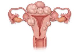 Yes, you can have uterine fibroids in your 20s and 30s – here are ...