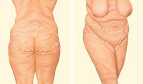 Body Lift Surgery Is Used To Improve The Shape And Tone Of Underlying Tissue Dr Gaby Doumit Sp Body Lift Surgery Brazilian Buttlift Surgery Buttlift Surgery
