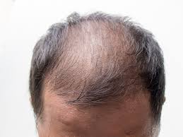The military classic, the high and tight, is great for men with thinning hair. How Do Hollywood Actors Avoid Male Pattern Baldness Quora