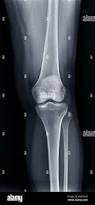 Image result for Knee XRay