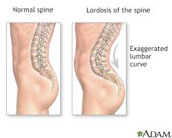 S1 ← unifromshape(t argetgenus + 1) 4: Lordosis Lumbar Information Mount Sinai New York